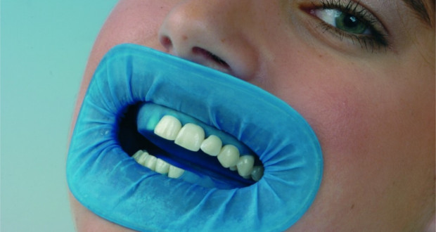 Кофердам в стоматології, що це і для чого